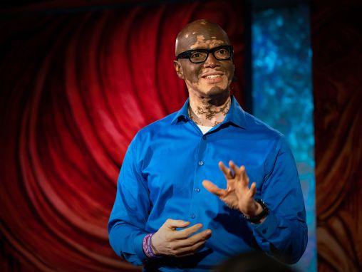 Lee Thomas: İnsanların vitiligoyu anlamalarına nasıl yardım ediyorum